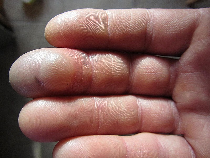 #13 Gelure : Bonne cloque ce matin ça évolue bien Gelure : Bonne cloque ce matin ça évolue bien